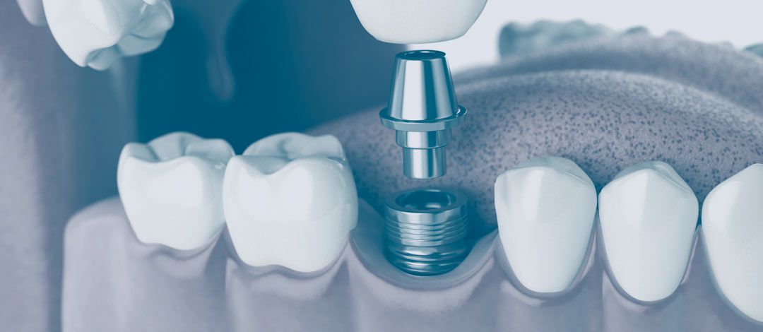 Implantes dentales Sevilla